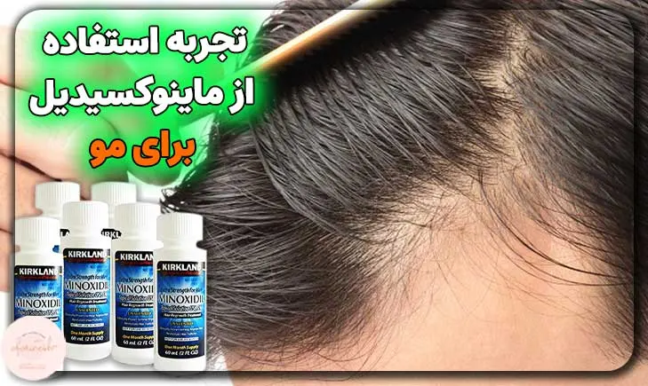 تجربه استفاده کنندگان از ماینوکسیدیل برای مو