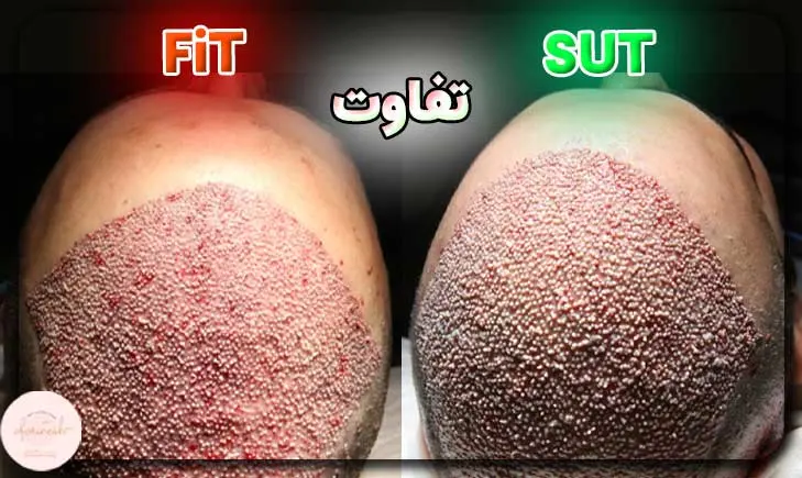 تفاوت کاشت مو به روش fit و sut