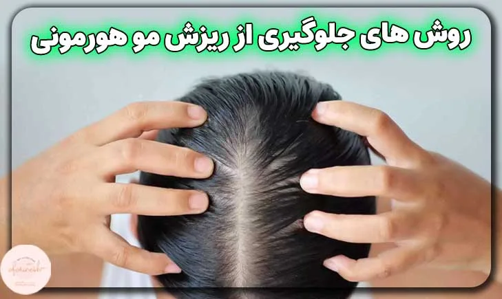 روش های جلوگیری از ریزش مو هورمونی