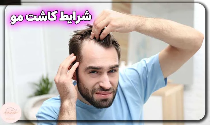 شرایط کاشت مو