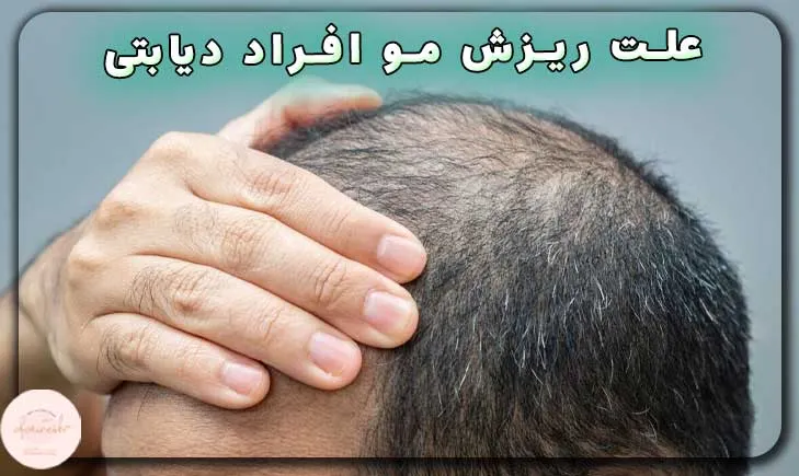 علت ریزش مو افراد دیابتی