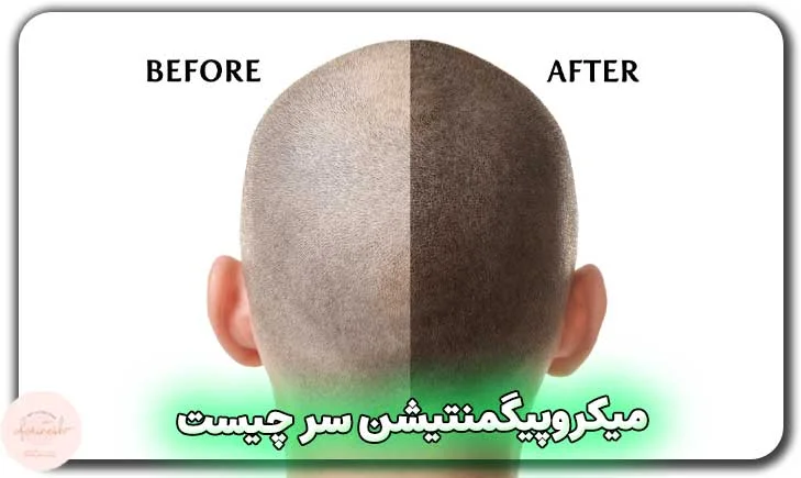 میکروپیگمنتیشن سر چیست