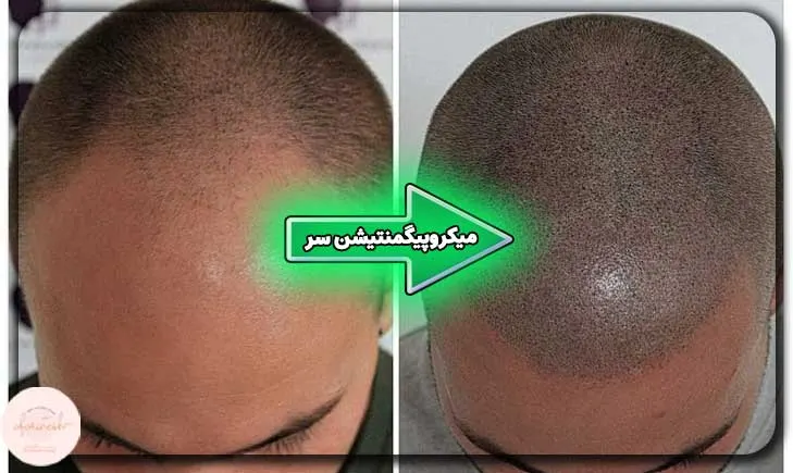 نحوه میکروپیگمنتیشن سر