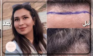 کاشت مو برای زنان