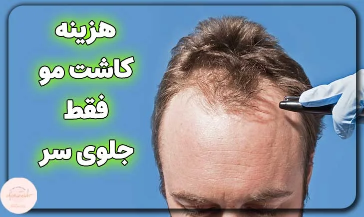 هزینه کاشت مو فقط جلوی سر
