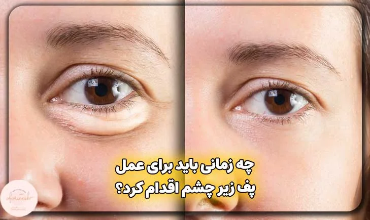 چه زمانی باید برای عمل پف زیر چشم اقدام کرد؟