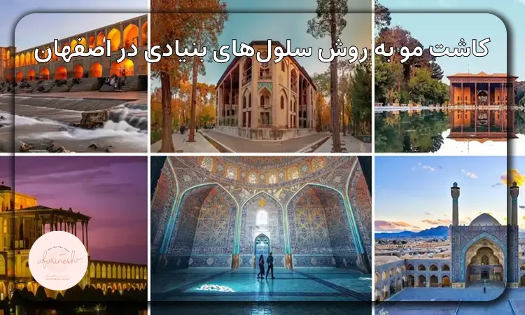 کاشت مو به روش سلولهای بنیادی در اصفهان