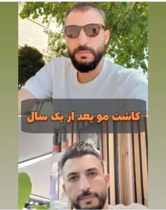 کاشت مو بعد از یکسال