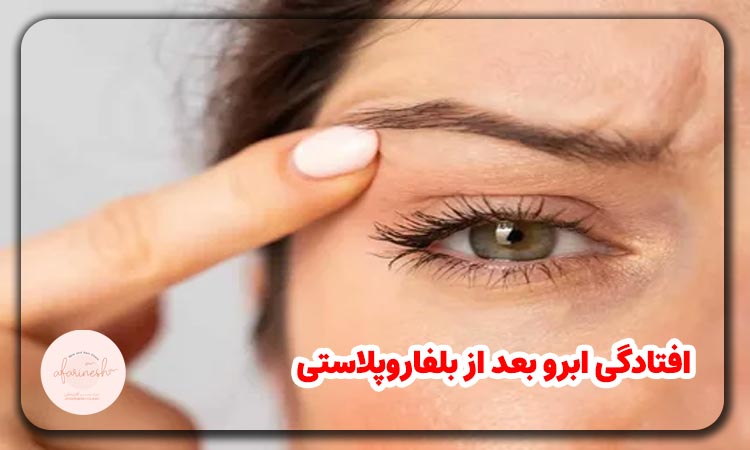 افتادگی ابرو بعد از بلفاروپلاستی