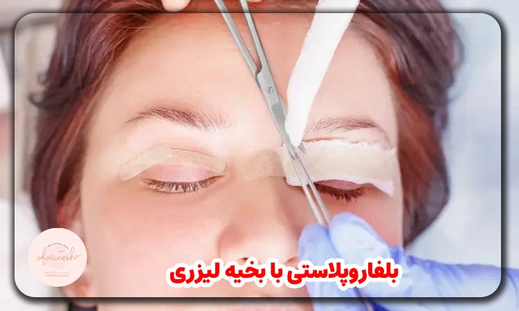 بلفاروپلاستی با بخیه لیزری