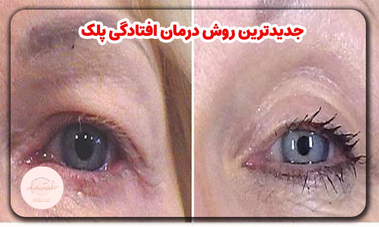 جدیدترین روش درمان افتادگی پلک