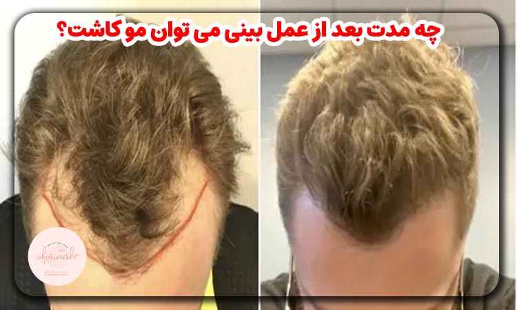 چه مدت بعد از عمل بینی می ‌توان مو کاشت؟