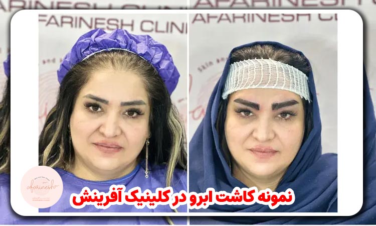 کاشت ابرو