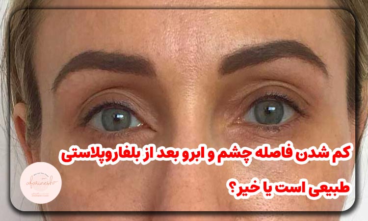 کم شدن فاصله چشم و ابرو بعد از بلفاروپلاستی