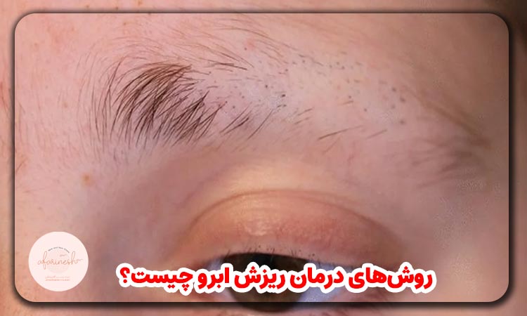 درمان ریزش ابرو