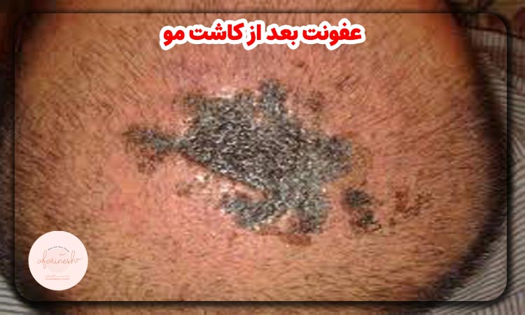 عفونت بعد از کاشت مو