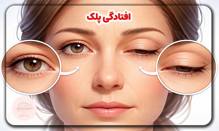 افتادگی پلک