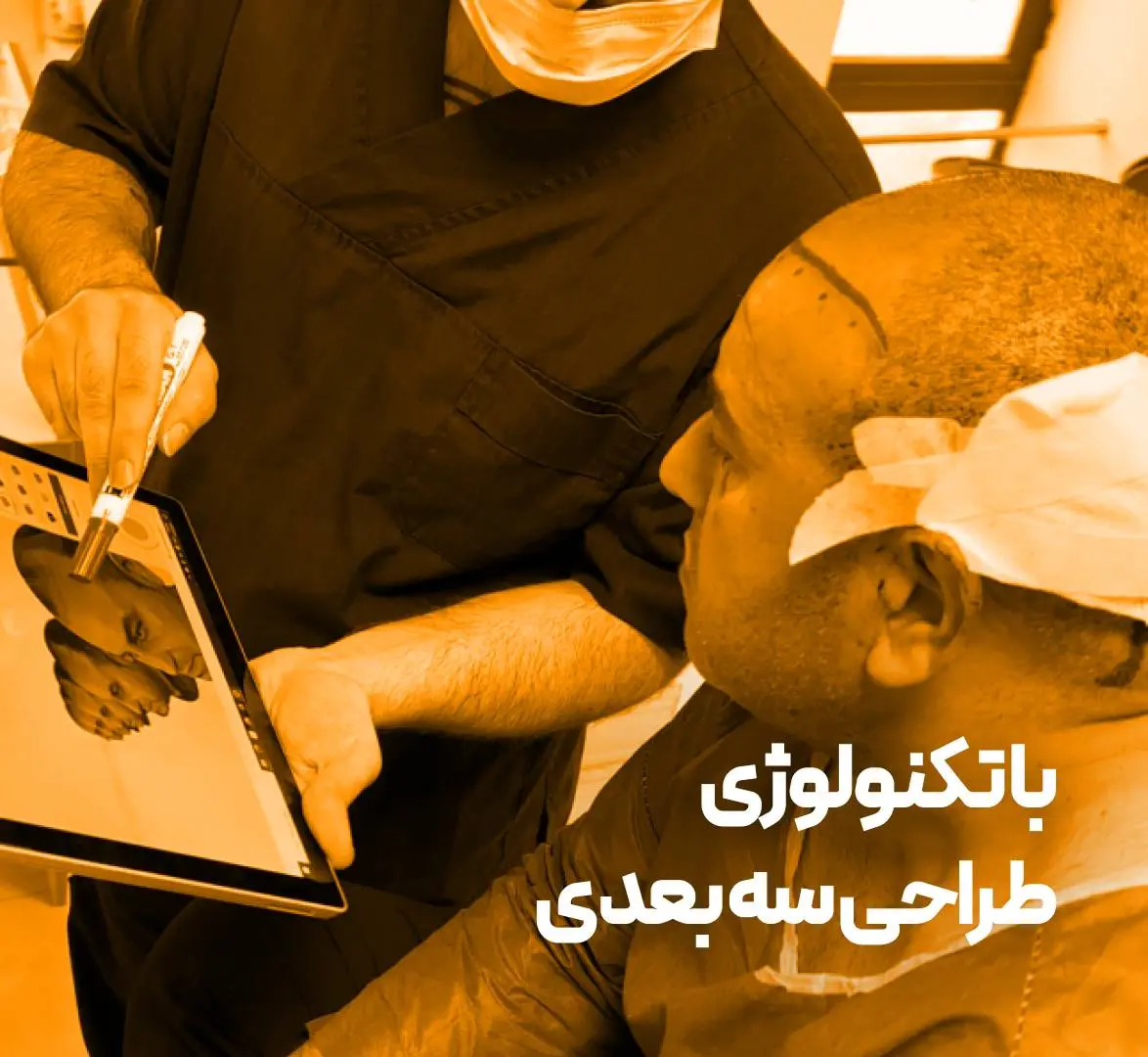 کاشت مو