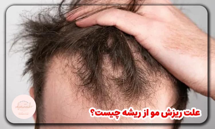 علت ریزش مو از ریشه چیست