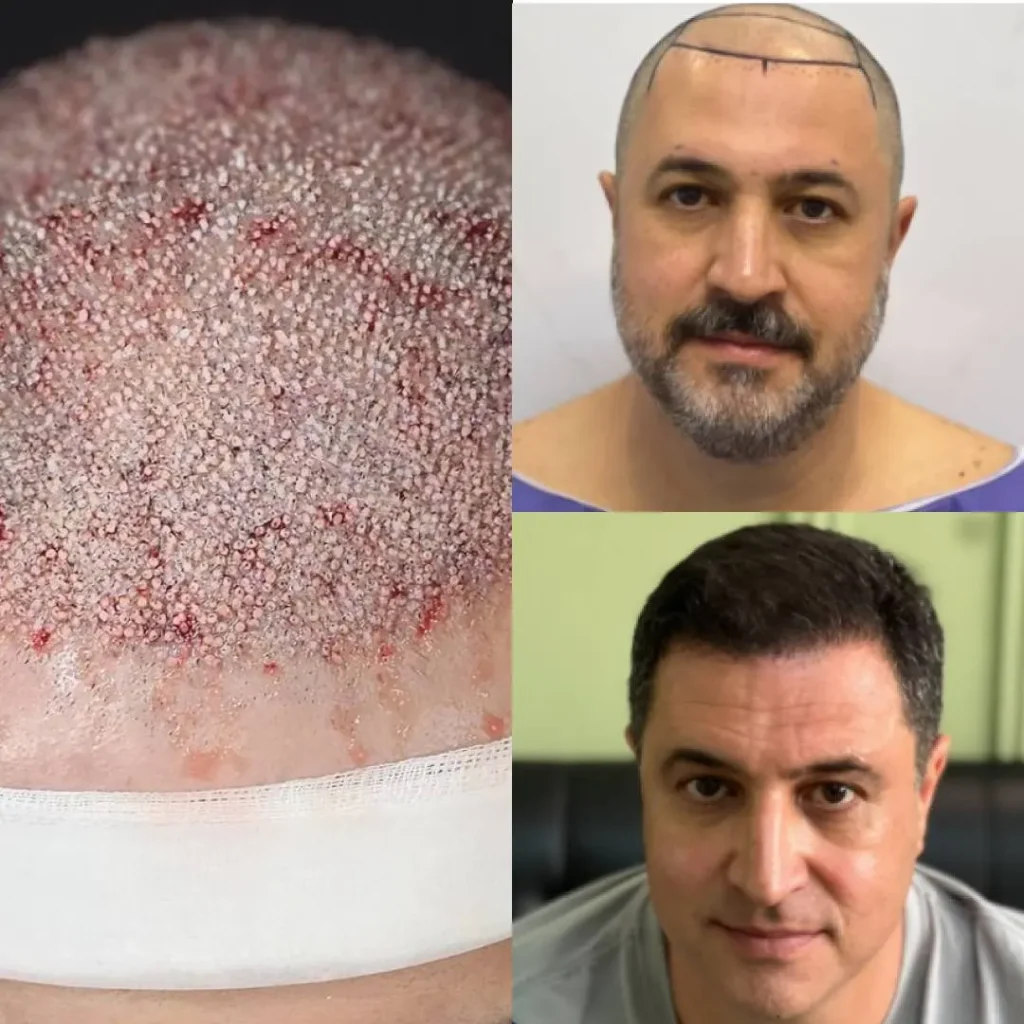 قبل و بعد کاشت مو