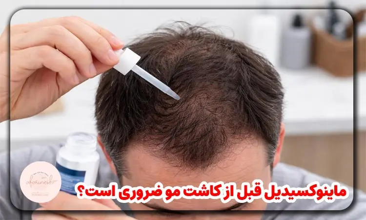 ماینوکسیدیل قبل از کاشت مو