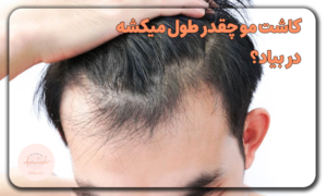 کاشت مو چقدر طول میکشه در بیاد