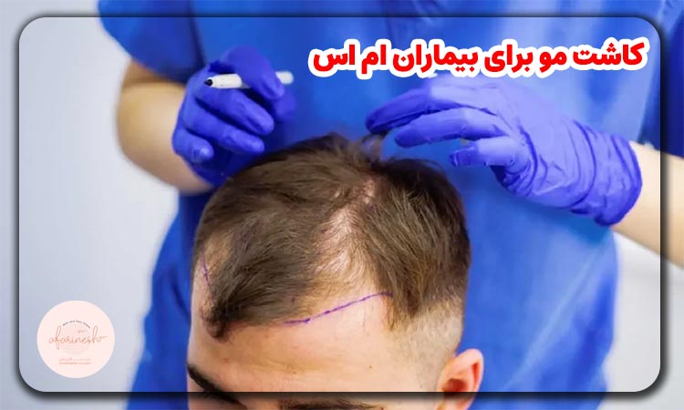 کاشت مو برای بیماران ام اس