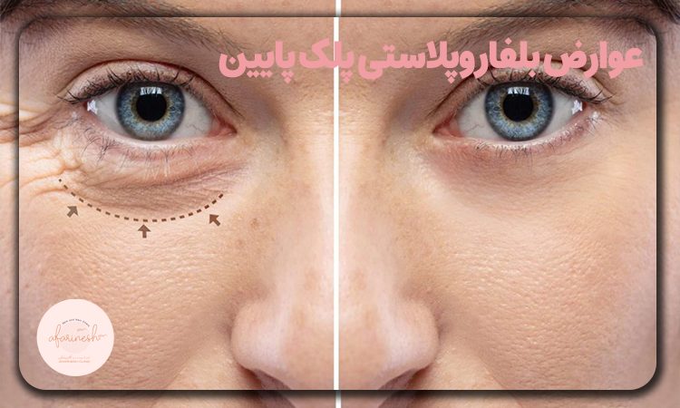 عوارض بلفاروپلاستی پلک پایین