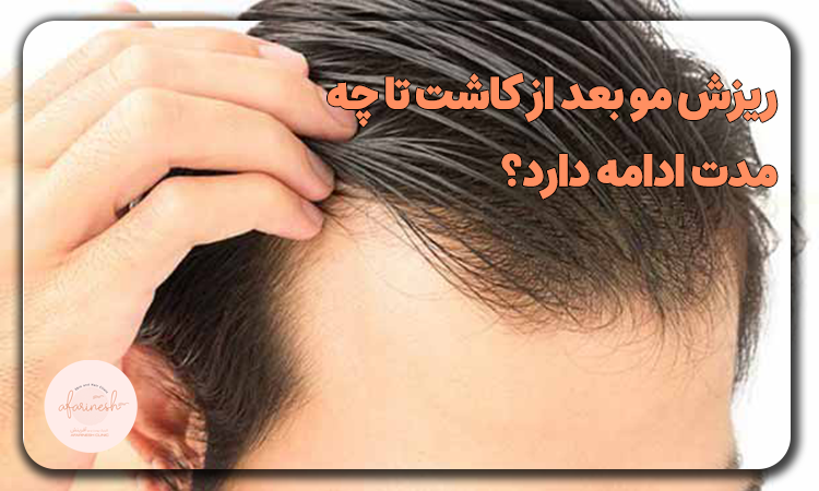 ریزش مو بعد از کاشت تا چه مدت ادامه دارد؟