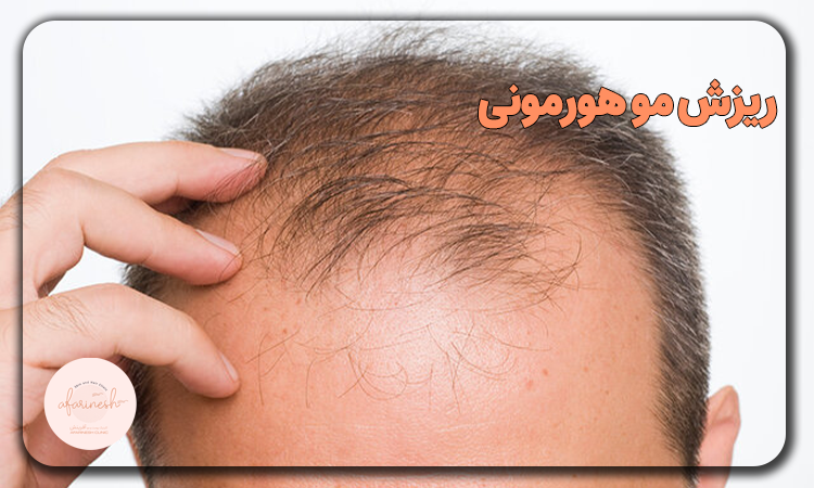 ریزش مو هورمونی