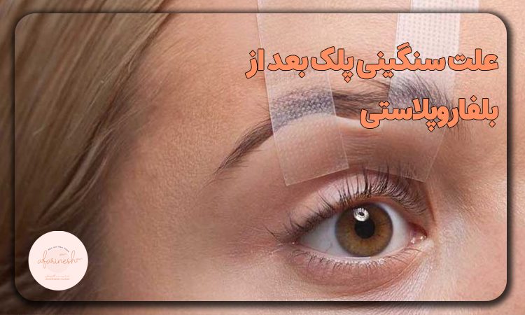 علت سنگینی پلک بعد از بلفاروپلاستی