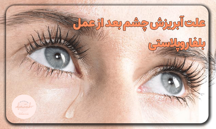 علت آبریزش چشم بعد از عمل بلفاروپلاستی