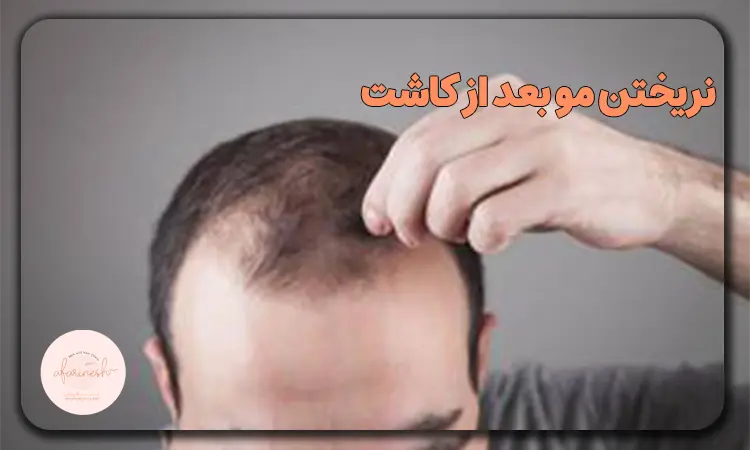 نریختن مو بعد از کاشت