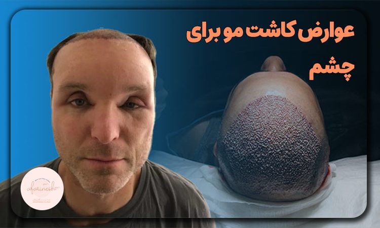 عوارض کاشت مو برای چشم