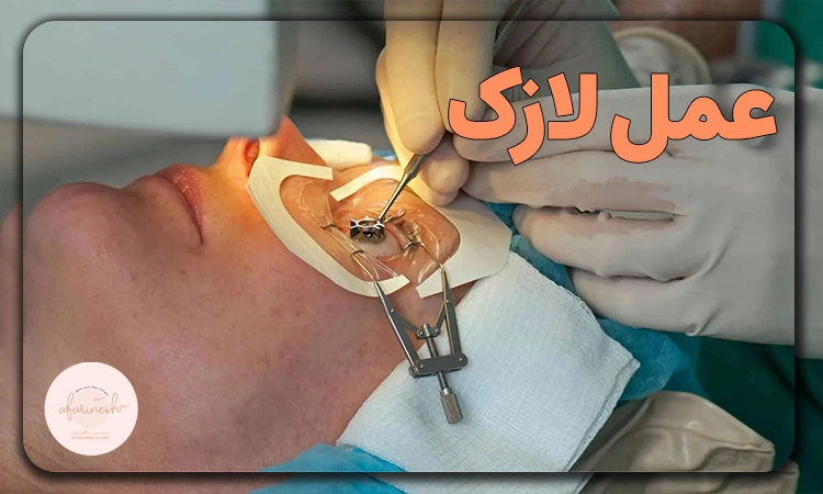 عمل لازک