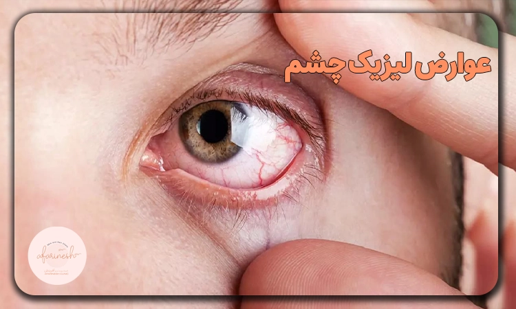 عوارض لیزیک چشم