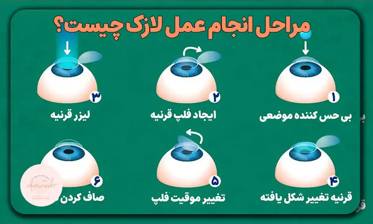 مراحل انجام عمل لازک چیست؟