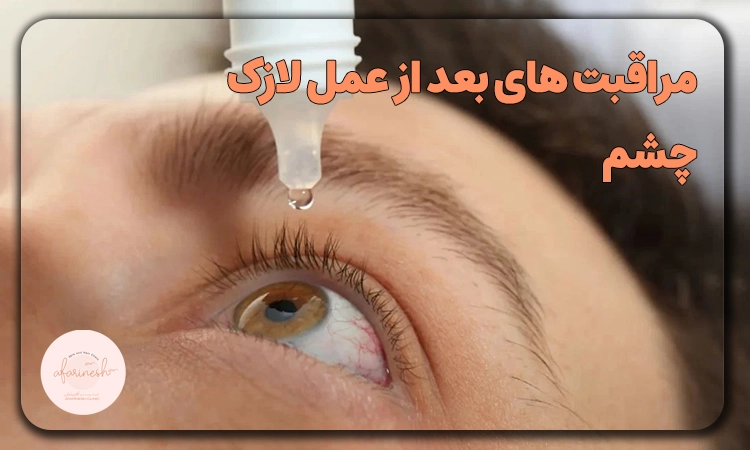 مراقبت های بعد از عمل لازک چشم