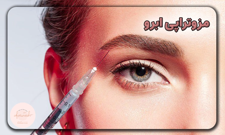 مزوتراپی ابرو
