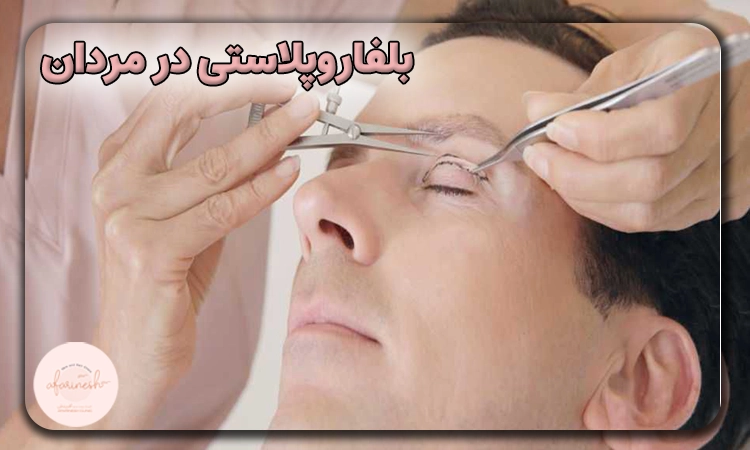 بلفاروپلاستی مردان