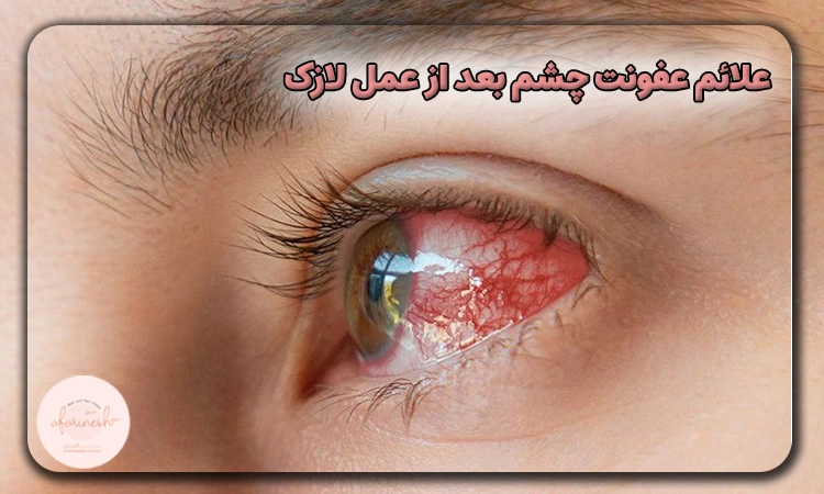 علائم عفونت چشم بعد از عمل لازک