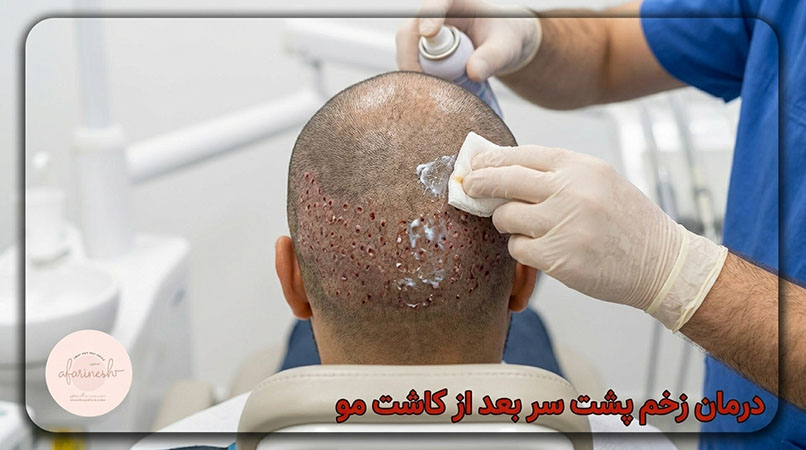 درمان زخم پشت سر بعد از کاشت مو
