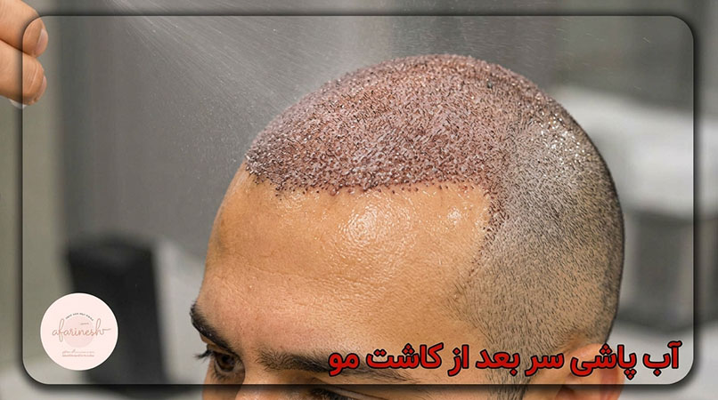 آب پاشی سر بعد از کاشت مو