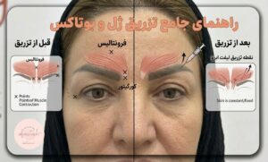 راهنمای جامع تزریق ژل و بوتاکس